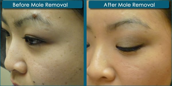Before and After photos of Mole Removal procedure Yelp