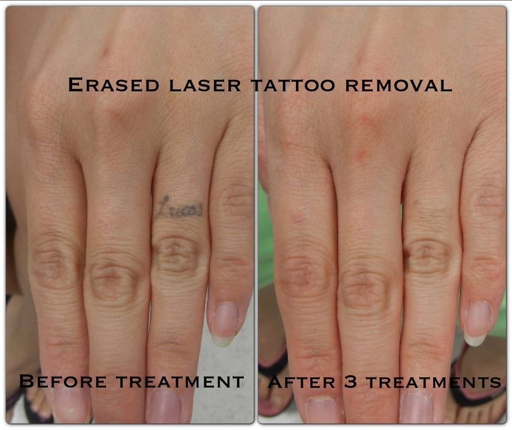 Tattoo Removal Cream Before And After Erased tattoo removal las